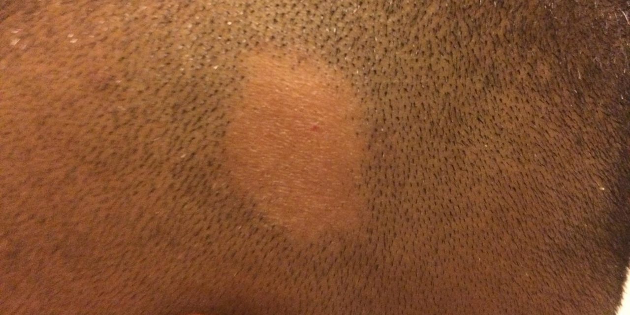 Alopecia areata