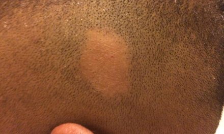 Alopecia areata