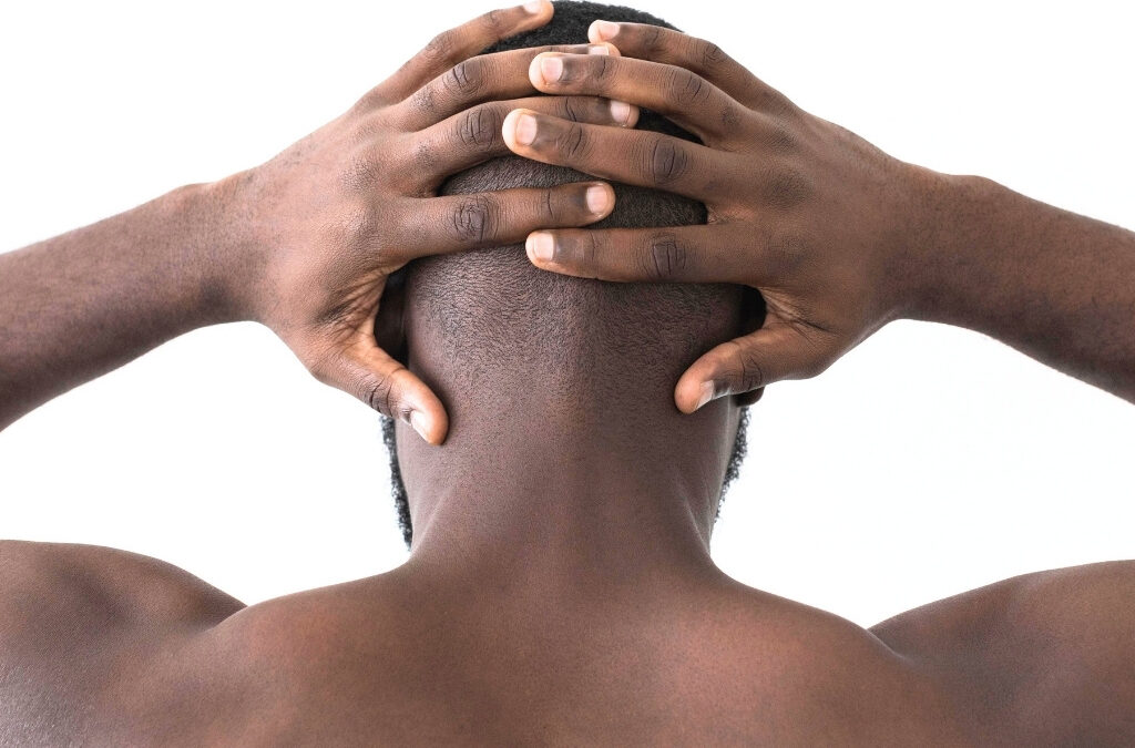 Alopecia areata